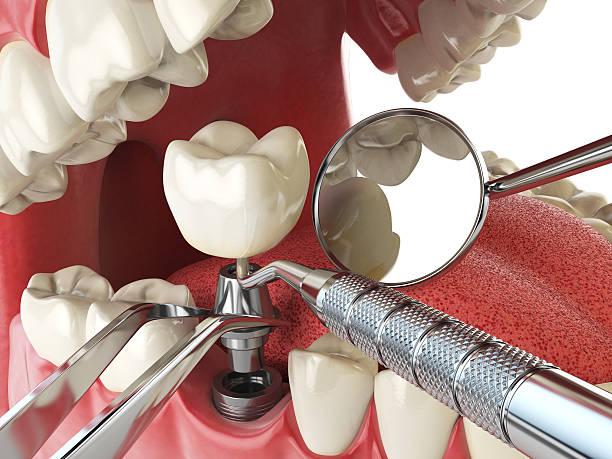 Best Emergency Root Canal Treatment in Roswell, GA